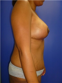 Breast Lift After Photo by Mark Markarian, MD, MSPH, FACS; Wellesley, MA - Case 31812