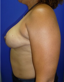 Breast Reduction After Photo by Mark Markarian, MD, MSPH, FACS; Wellesley, MA - Case 31813