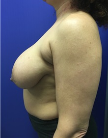 Breast Reduction Before Photo by Mark Markarian, MD, MSPH, FACS; Wellesley, MA - Case 31813