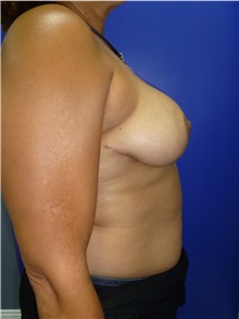 Breast Reduction After Photo by Mark Markarian, MD, MSPH, FACS; Wellesley, MA - Case 31813
