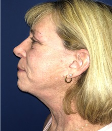 Facelift After Photo by Mark Markarian, MD, MSPH, FACS; Wellesley, MA - Case 31825