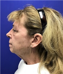 Facelift Before Photo by Mark Markarian, MD, MSPH, FACS; Wellesley, MA - Case 31825