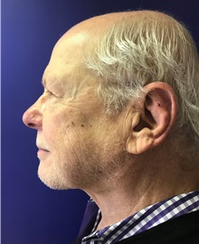 Facelift After Photo by Mark Markarian, MD, MSPH, FACS; Wellesley, MA - Case 31826