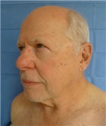 Facelift Before Photo by Mark Markarian, MD, MSPH, FACS; Wellesley, MA - Case 31826