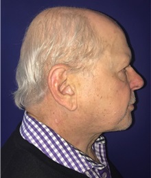 Facelift After Photo by Mark Markarian, MD, MSPH, FACS; Wellesley, MA - Case 31826