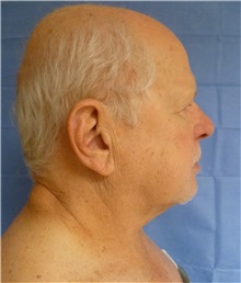 Facelift Before Photo by Mark Markarian, MD, MSPH, FACS; Wellesley, MA - Case 31826