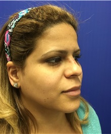 Dermal Fillers After Photo by Mark Markarian, MD, MSPH, FACS; Wellesley, MA - Case 31840
