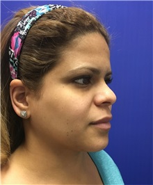 Dermal Fillers Before Photo by Mark Markarian, MD, MSPH, FACS; Wellesley, MA - Case 31840