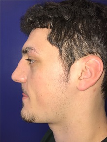 Rhinoplasty After Photo by Mark Markarian, MD, MSPH, FACS; Wellesley, MA - Case 31845