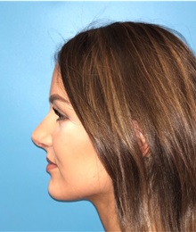 Rhinoplasty After Photo by Mark Markarian, MD, MSPH, FACS; Wellesley, MA - Case 37715