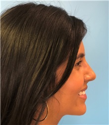 Rhinoplasty After Photo by Mark Markarian, MD, MSPH, FACS; Wellesley, MA - Case 37716