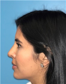 Rhinoplasty After Photo by Mark Markarian, MD, MSPH, FACS; Wellesley, MA - Case 37716