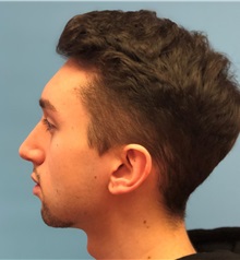 Rhinoplasty After Photo by Mark Markarian, MD, MSPH, FACS; Wellesley, MA - Case 37717