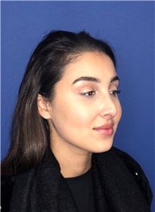 Rhinoplasty After Photo by Mark Markarian, MD, MSPH, FACS; Wellesley, MA - Case 37718