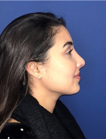 Rhinoplasty After Photo by Mark Markarian, MD, MSPH, FACS; Wellesley, MA - Case 37718
