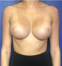 Breast Augmentation After Photo by Mark Markarian, MD, MSPH, FACS; Wellesley, MA - Case 37726