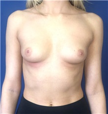 Breast Augmentation Before Photo by Mark Markarian, MD, MSPH, FACS; Wellesley, MA - Case 37726