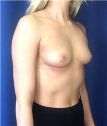 Breast Augmentation Before Photo by Mark Markarian, MD, MSPH, FACS; Wellesley, MA - Case 37726