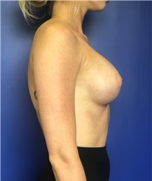 Breast Augmentation After Photo by Mark Markarian, MD, MSPH, FACS; Wellesley, MA - Case 37726