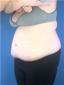 Tummy Tuck Before Photo by Mark Markarian, MD, MSPH, FACS; Wellesley, MA - Case 37729