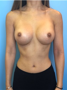 Breast Augmentation After Photo by Mark Markarian, MD, MSPH, FACS; Wellesley, MA - Case 38048