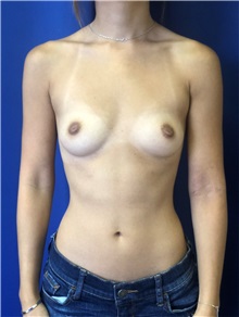 Breast Augmentation Before Photo by Mark Markarian, MD, MSPH, FACS; Wellesley, MA - Case 38048