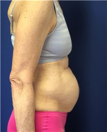 Tummy Tuck Before Photo by Mark Markarian, MD, MSPH, FACS; Wellesley, MA - Case 38049