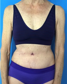 Tummy Tuck After Photo by Mark Markarian, MD, MSPH, FACS; Wellesley, MA - Case 38049