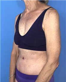 Tummy Tuck After Photo by Mark Markarian, MD, MSPH, FACS; Wellesley, MA - Case 38049