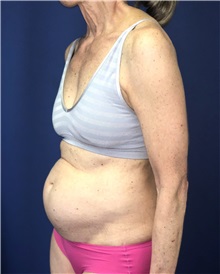 Tummy Tuck Before Photo by Mark Markarian, MD, MSPH, FACS; Wellesley, MA - Case 38049