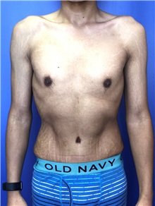 Tummy Tuck After Photo by Mark Markarian, MD, MSPH, FACS; Wellesley, MA - Case 38051