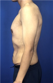 Tummy Tuck Before Photo by Mark Markarian, MD, MSPH, FACS; Wellesley, MA - Case 38051