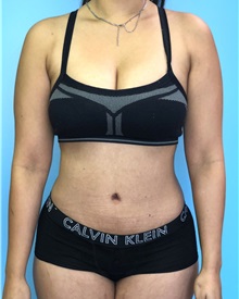 Tummy Tuck After Photo by Mark Markarian, MD, MSPH, FACS; Wellesley, MA - Case 38052