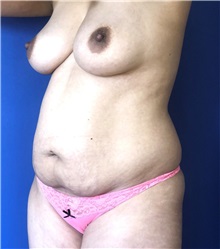 Tummy Tuck Before Photo by Mark Markarian, MD, MSPH, FACS; Wellesley, MA - Case 38052
