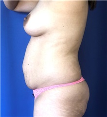 Tummy Tuck Before Photo by Mark Markarian, MD, MSPH, FACS; Wellesley, MA - Case 38052