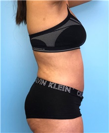 Tummy Tuck After Photo by Mark Markarian, MD, MSPH, FACS; Wellesley, MA - Case 38052