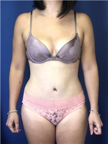 Tummy Tuck After Photo by Mark Markarian, MD, MSPH, FACS; Wellesley, MA - Case 38053