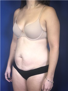 Tummy Tuck Before Photo by Mark Markarian, MD, MSPH, FACS; Wellesley, MA - Case 38053