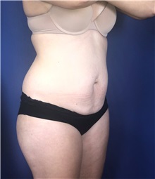 Tummy Tuck Before Photo by Mark Markarian, MD, MSPH, FACS; Wellesley, MA - Case 38053