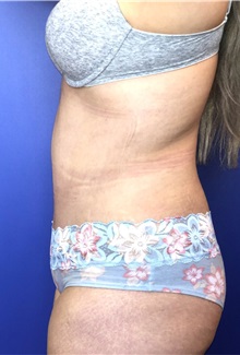 Tummy Tuck After Photo by Mark Markarian, MD, MSPH, FACS; Wellesley, MA - Case 38055