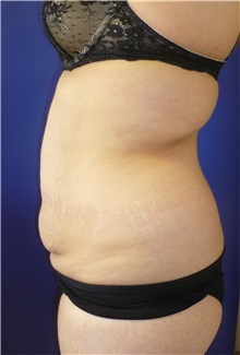 Tummy Tuck Before Photo by Mark Markarian, MD, MSPH, FACS; Wellesley, MA - Case 38055