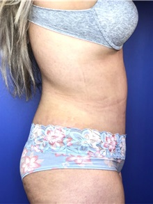 Tummy Tuck After Photo by Mark Markarian, MD, MSPH, FACS; Wellesley, MA - Case 38055