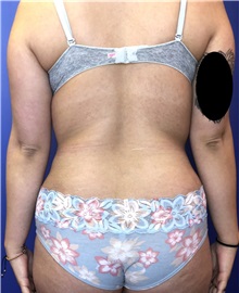Liposuction After Photo by Mark Markarian, MD, MSPH, FACS; Wellesley, MA - Case 38056