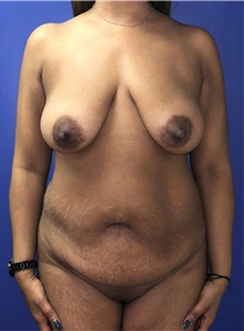 Tummy Tuck Before Photo by Mark Markarian, MD, MSPH, FACS; Wellesley, MA - Case 38057