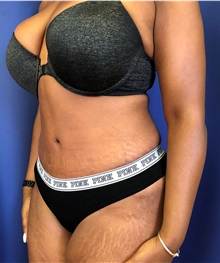 Tummy Tuck After Photo by Mark Markarian, MD, MSPH, FACS; Wellesley, MA - Case 38057