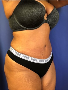 Tummy Tuck After Photo by Mark Markarian, MD, MSPH, FACS; Wellesley, MA - Case 38057
