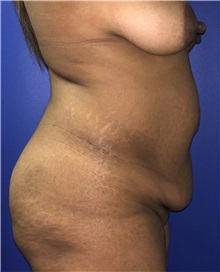 Tummy Tuck Before Photo by Mark Markarian, MD, MSPH, FACS; Wellesley, MA - Case 38057