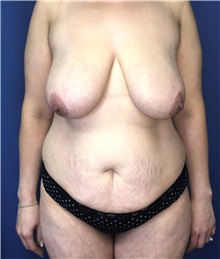Tummy Tuck Before Photo by Mark Markarian, MD, MSPH, FACS; Wellesley, MA - Case 38058