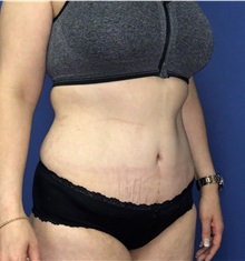 Tummy Tuck After Photo by Mark Markarian, MD, MSPH, FACS; Wellesley, MA - Case 38058