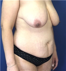 Tummy Tuck Before Photo by Mark Markarian, MD, MSPH, FACS; Wellesley, MA - Case 38058